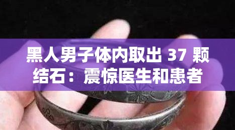 黑人男子体内取出 37 颗结石：震惊医生和患者