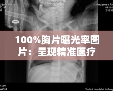 100%胸片曝光率图片：呈现精准医疗影像细节